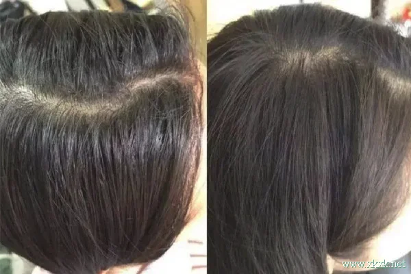 头发为什么总是很油 头发出油要及时洗掉吗