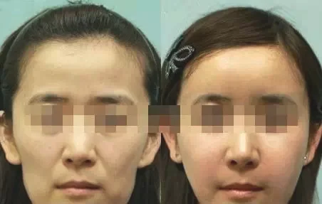 伊美尔新年推荐：这些整形项目让你美美过新年~