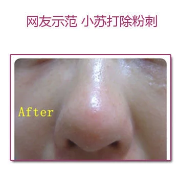 DIY小苏打面膜 除粉刺温和干净