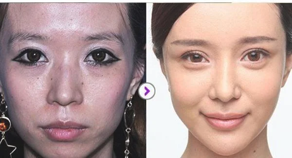 做点痣需要多少钱？费用是多少？