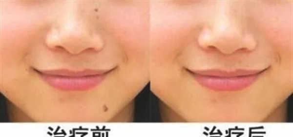 做切除手术去黑痣的流程是什么？恢复时间要多久？