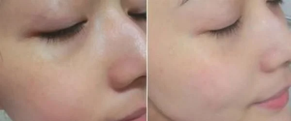 做E光去红血丝的流程是什么？恢复时间要多久？
