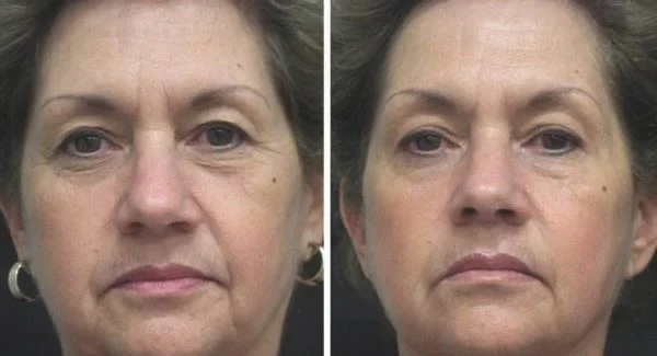 做胶原蛋白去法令纹禁忌人群及适宜人群有哪些？