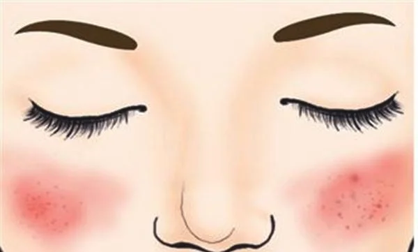 做光子祛红血丝的步骤及注意事项