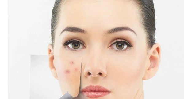 做冷冻治疗去痘疤需要多长时间？全过程解析