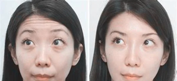 做内窥镜除皱去抬头纹费用多少钱