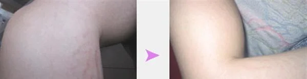 激光去妊娠纹手术术后护理？