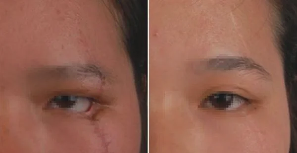 面部疤痕修复需要怎么护理?