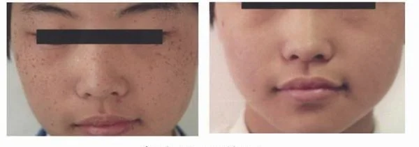 冷冻法去雀斑手术效果好不好?