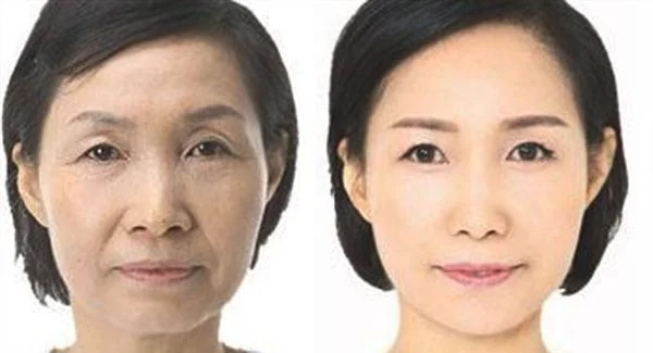 做童颜紧肤术价格要多少