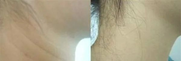 做激光除颈纹价格贵不贵