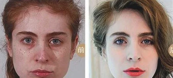 做冷冻法去黄褐斑治疗效果怎么样？效果保持时间多久？