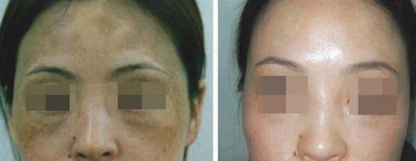 皮肤磨削治太田痣手术安全吗？
