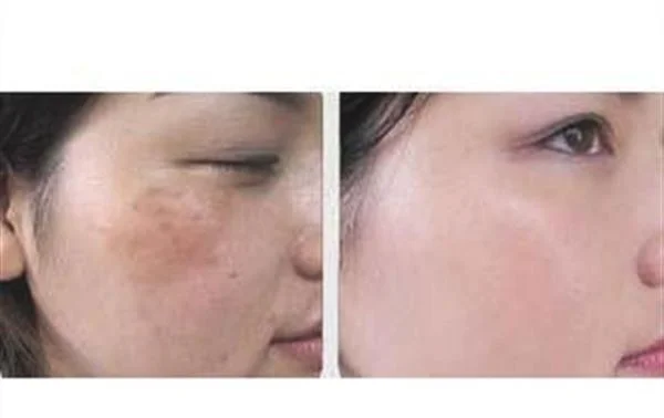 做彩光祛斑多少钱