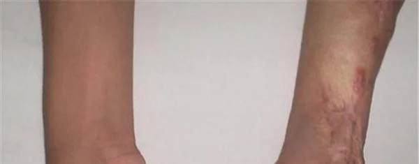 烫伤疤痕修复恢复需要注意什么？