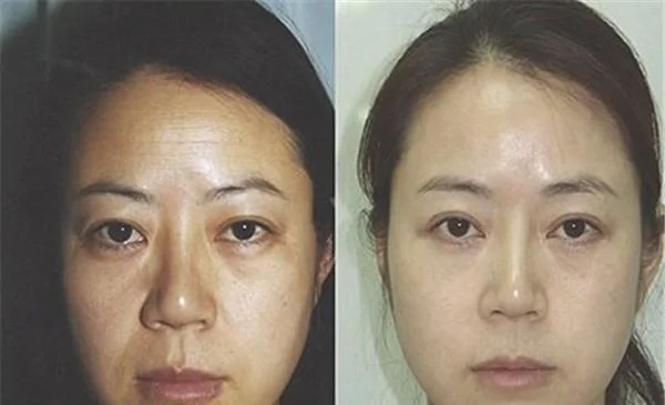 做内窥镜除皱去抬头纹价格
