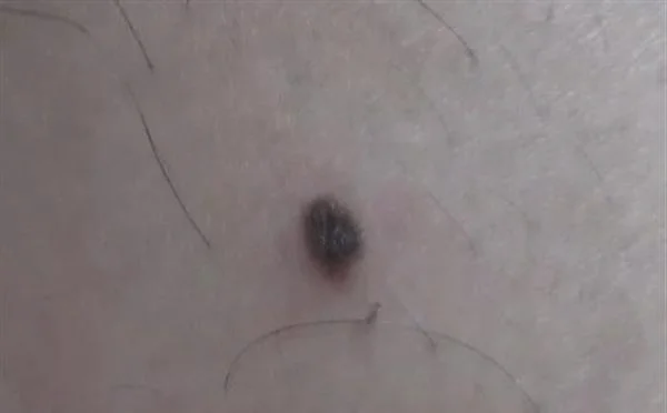 做切除手术去黑痣手术多少钱？