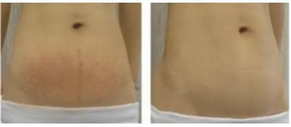 做光子去妊娠纹手术多少钱？