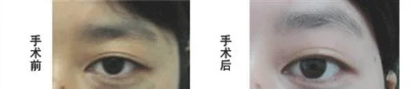 剥脱治疗太田痣手术术后护理?