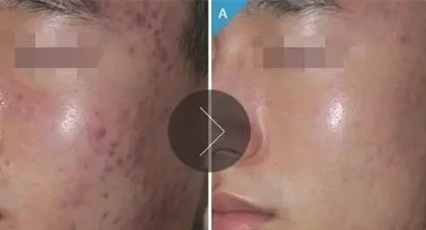 切除缝合治疗痘疤一般维持多长时间？