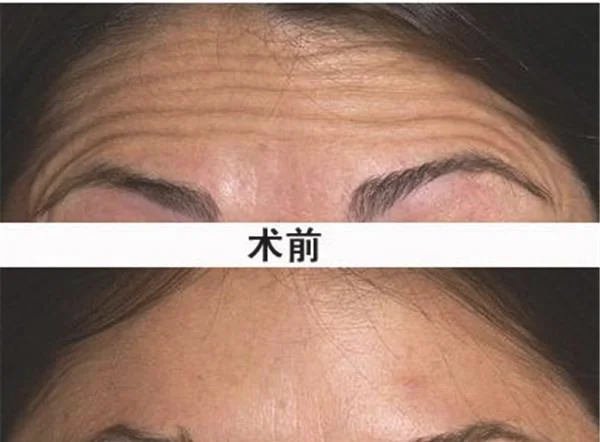 做爱贝芙去除抬头纹价格