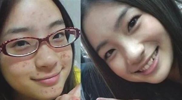 红蓝光祛痘怎么护理?