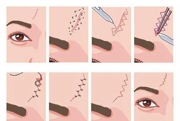 祛疤手术效果好不好?