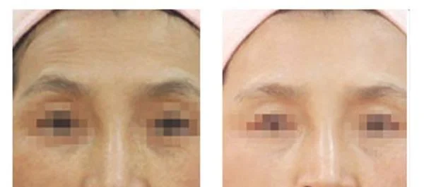 爱贝芙去除抬头纹优点是什么？