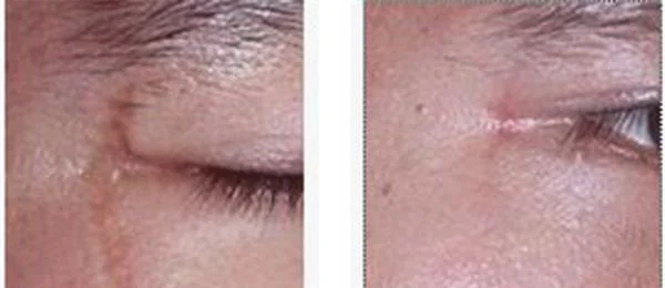 做面部疤痕修复价格是多少