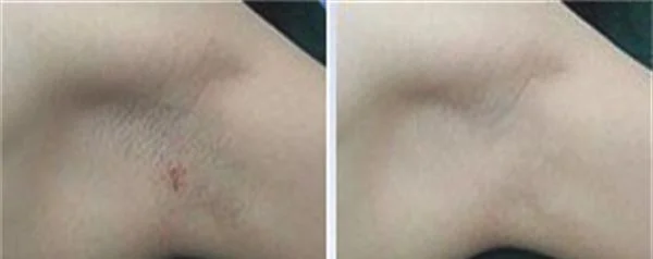 做切除法去腋臭治疗效果怎么样？效果保持时间多久？