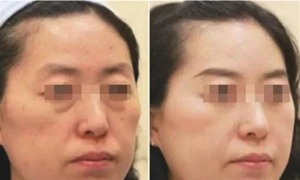 去粉刺手术注意事项是什么？