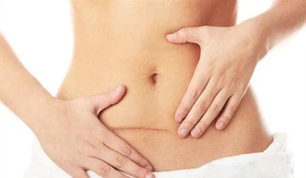 疤痕增生修复注意事项是什么?