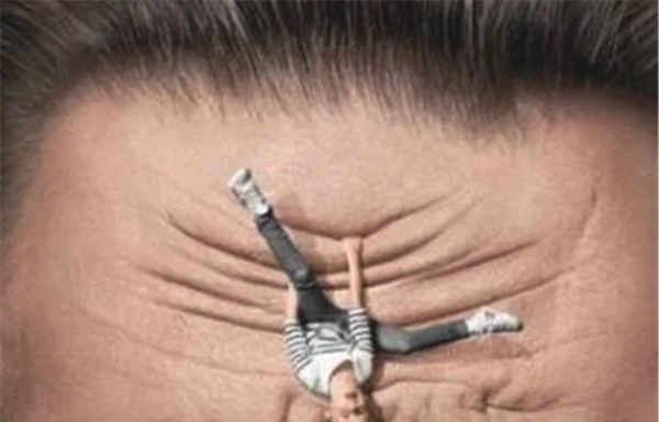 玻尿酸去抬头纹优点是什么？