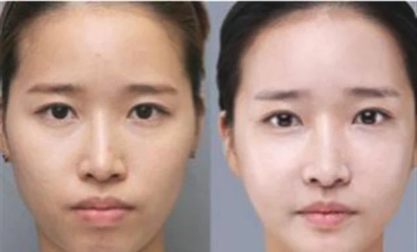 做E光嫩肤费用大概需要多少