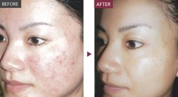 激光祛痘手术注意事项是什么？