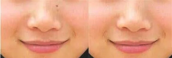 做冷冻去痣治疗效果怎么样？效果保持时间多久？