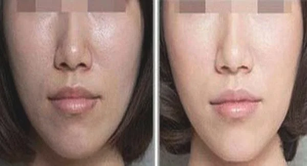 做光子嫩肤价格贵吗