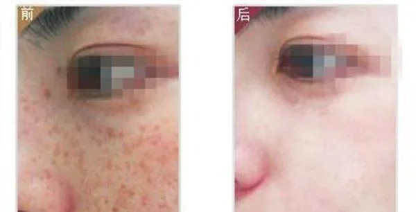 做光子祛斑费用大概需要多少
