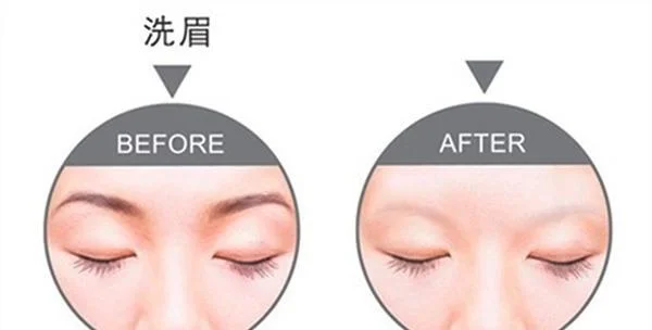 脉冲光去眉间纹手术术后护理？