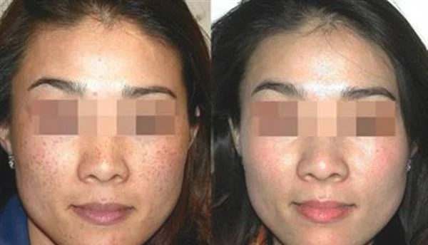 做激光祛斑多少钱