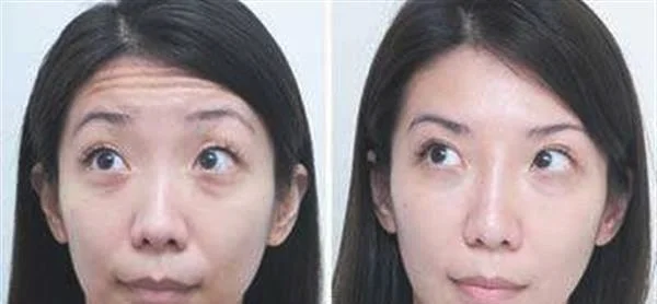 光子除抬头纹手术安全吗？
