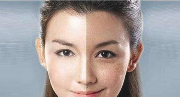 做祛斑手术注意事项是什么？