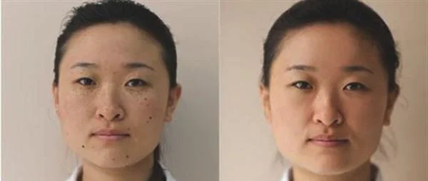 激光去雀斑手术安全吗？