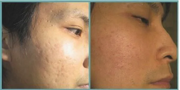 做冷冻治疗去痘疤价格要多少