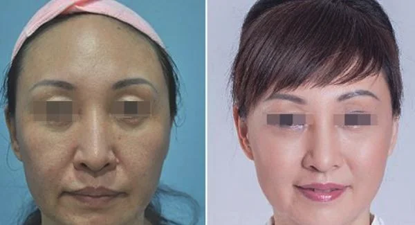 做激光美容治疗效果怎么样？效果保持时间多久？