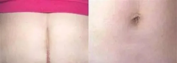 做剖腹产疤痕修复手术多少钱?