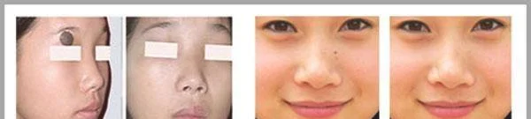 做冷冻去痣手术多少钱？