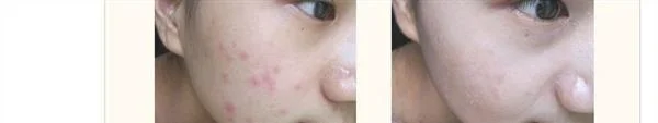 做果酸换肤袪痘疤手术多少钱？