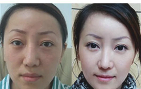 做红蓝光美肤价格