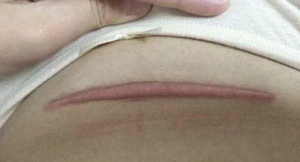 做剖腹产疤痕修复手术注意事项是什么?